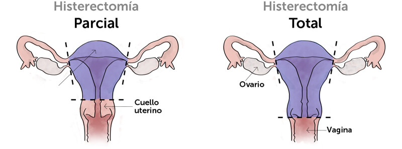 Histerectoma