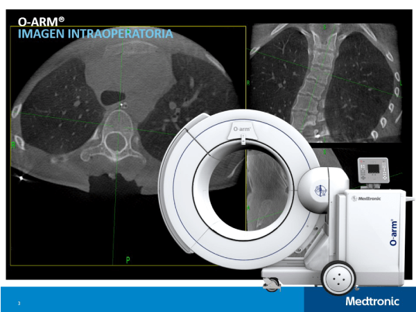 Sistema O-arm, visualizacin de cirugas de la columna vertebral en tiempo real