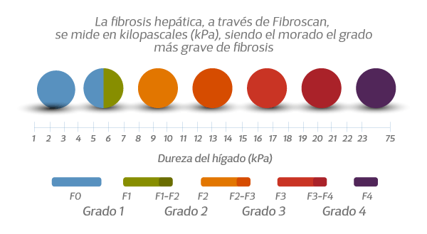 fibrosis en 4 etapas